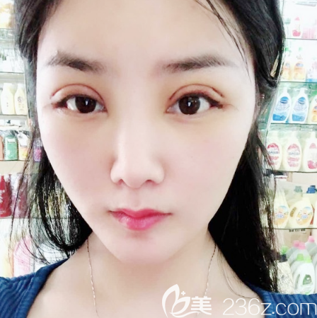 全切雙眼皮術(shù)后兩天恢復(fù)效果圖 全切雙眼皮術(shù)后兩天恢復(fù)效果圖