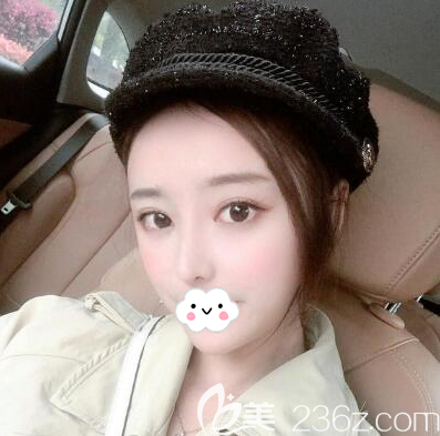 成都天姿（原恒博）整形美容醫(yī)院李烈給我做面部吸脂3個月了，恢復期的時候我覺得自己每天都不一樣