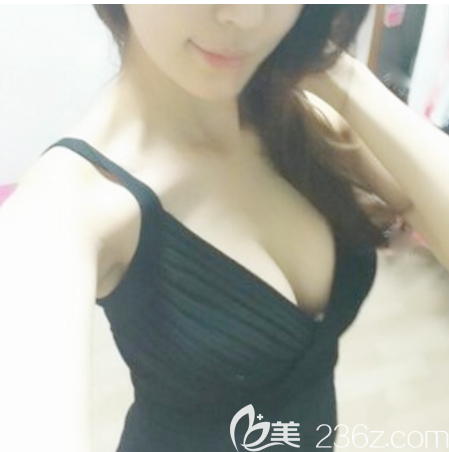 假體隆胸術(shù)后7天拆線 假體隆胸術(shù)后7天拆線