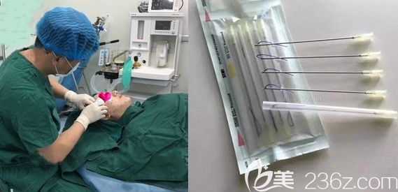 長春中妍整形面部埋線提升術(shù)中照