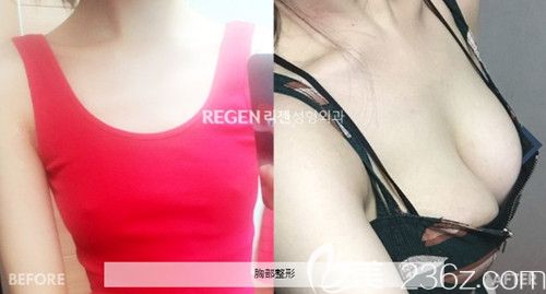 韓國麗珍假體隆胸手術(shù)案例 韓國麗珍假體隆胸手術(shù)案例