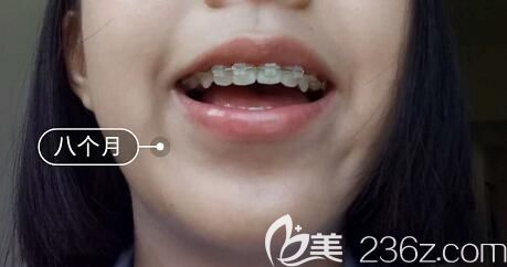 我在洛陽(yáng)九龍口腔做牙齒矯正第8個(gè)月