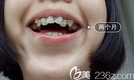我在洛陽(yáng)九龍口腔做牙齒矯正第2個(gè)月