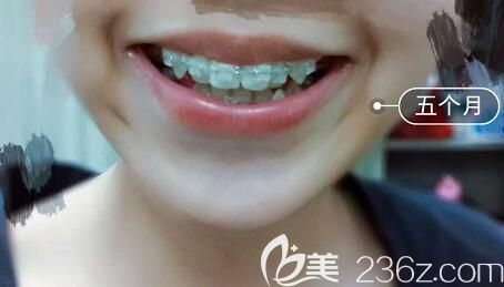 我在洛陽(yáng)九龍口腔做半隱形陶瓷托槽牙齒矯正5個(gè)月