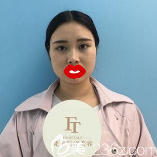 做雙眼皮術(shù)前照 做雙眼皮術(shù)前照