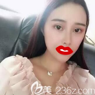 在長(zhǎng)沙做雙眼皮開眼角注射瘦臉術(shù)后45天<span style= 在長(zhǎng)沙做雙眼皮開眼角注射瘦臉術(shù)后45天<span style=