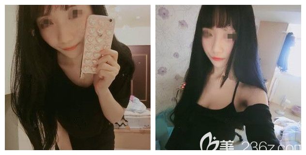 面診無錫麗都術前A罩杯 面診無錫麗都術前A罩杯