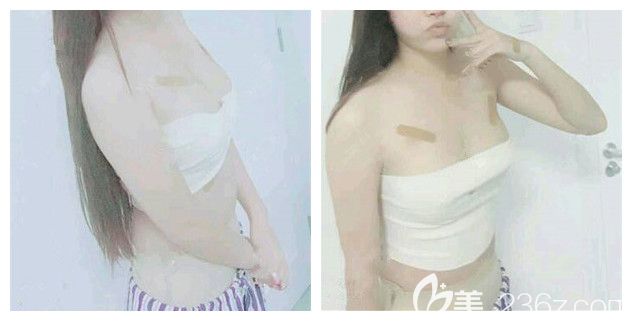 到無錫麗都剛做完自體脂肪豐胸術后 到無錫麗都剛做完自體脂肪豐胸術后