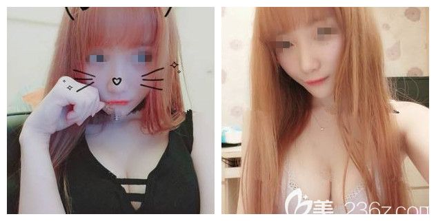 術后三個月自體脂肪豐胸效果 術后三個月自體脂肪豐胸效果