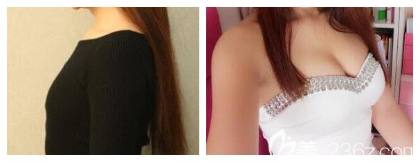 南寧韓成整形高靜醫(yī)生自體脂肪豐胸案例