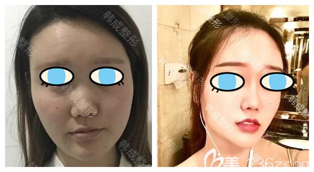 南寧韓成整形高靜院長鼻綜合隆鼻案例