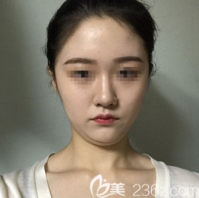 在韓國(guó)DI整形醫(yī)院做面部吸脂+墊下巴手術(shù)前 在韓國(guó)DI整形醫(yī)院做面部吸脂+墊下巴手術(shù)前