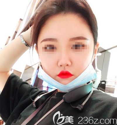 在韓國(guó)DI整形醫(yī)院做面部吸脂+墊下巴手術(shù)后21天 在韓國(guó)DI整形醫(yī)院做面部吸脂+墊下巴手術(shù)后21天