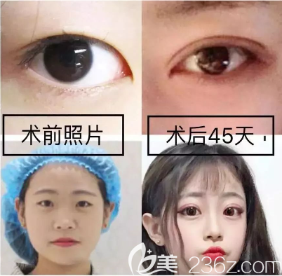 遵義韓美雙眼皮怎么樣 遵義韓美雙眼皮怎么樣