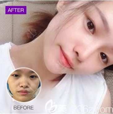 遵義韓美假體隆鼻 遵義韓美假體隆鼻