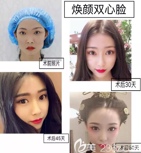 遵義韓美打瘦臉怎么樣 遵義韓美打瘦臉怎么樣