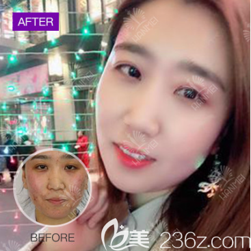 遵義韓美整形醫(yī)院祛痘好嗎 遵義韓美整形醫(yī)院祛痘好嗎