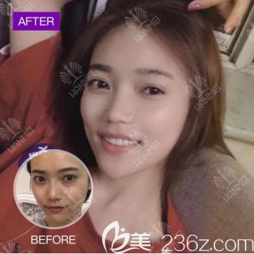 遵義韓美整形祛眼袋效果 遵義韓美整形祛眼袋效果