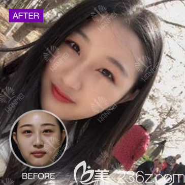 遵義韓美玻尿酸豐蘋果肌案例 遵義韓美玻尿酸豐蘋果肌案例