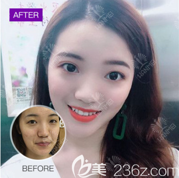 遵義韓美脂肪填充 遵義韓美脂肪填充