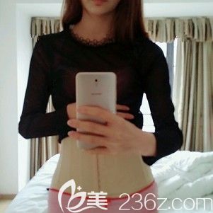 汪洋主任幫我做腰腹吸脂術(shù)后即刻