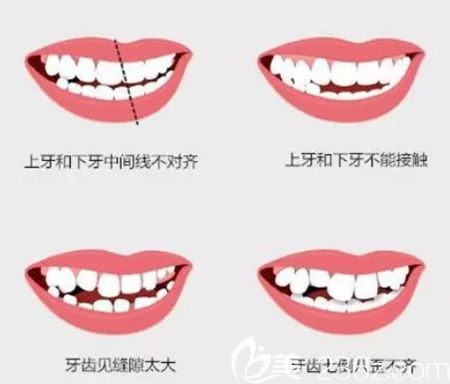 雙鄂手術(shù)可以改善的面部情況