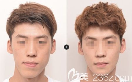 韓國EU雙鄂手術(shù)案例