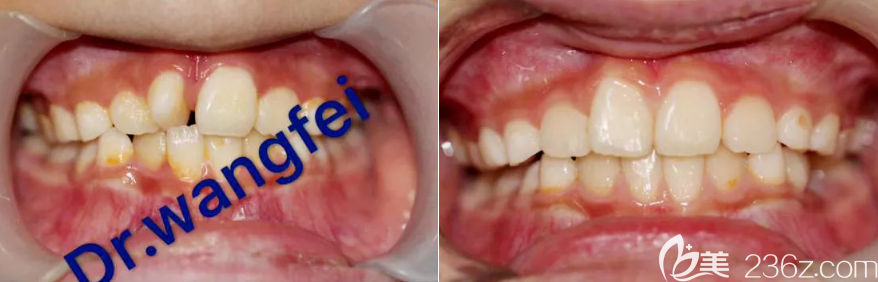 楊占娟院長(zhǎng)恒牙萌出異位早期干預(yù)案例效果 楊占娟院長(zhǎng)恒牙萌出異位早期干預(yù)案例效果