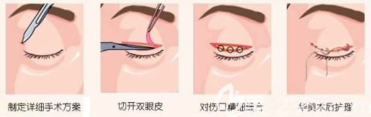 汕頭華美雙眼皮手術(shù)過程圖
