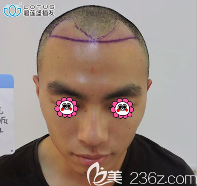 在北京碧蓮盛做額角種植和發(fā)際線修復設計照
