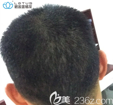 我在北京碧蓮盛做額角種植和發(fā)際線修復一個月后枕部樣子