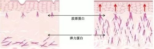 韓國(guó)清譚優(yōu)面部提升原理 韓國(guó)清譚優(yōu)面部提升原理