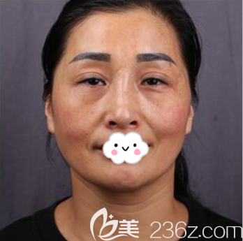 成都軍大整形外科醫(yī)院趙善軍術(shù)前照片1