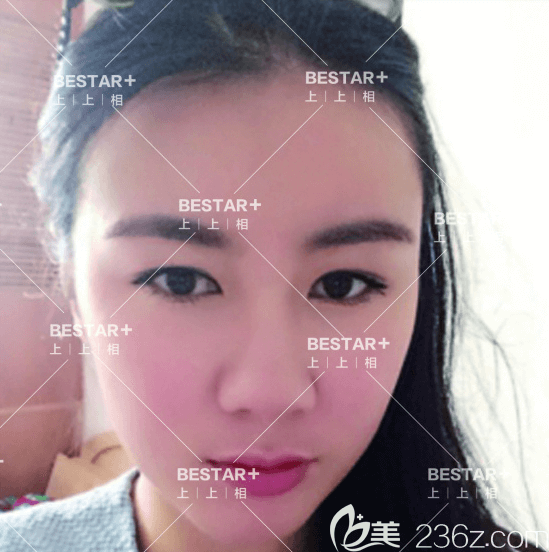 在北京上上相做蜂巢明星藝術(shù)面雕和雙眼皮手術(shù)一個(gè)月效果 在北京上上相做蜂巢明星藝術(shù)面雕和雙眼皮手術(shù)一個(gè)月效果