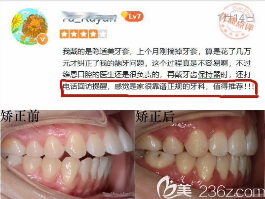 在做過隱適美矯正后的網(wǎng)評(píng)及矯正對(duì)比效果 在做過隱適美矯正后的網(wǎng)評(píng)及矯正對(duì)比效果
