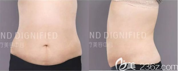 前年做的腰腹吸脂沒(méi)效果，今年在長(zhǎng)春姬安娣整形吸脂瘦腹后終于圓了我的減肥夢(mèng)！