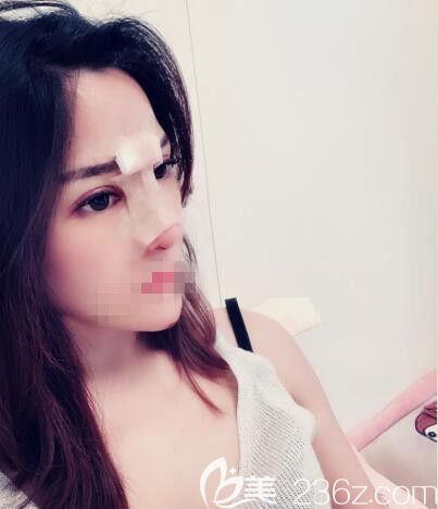 在鄭州藝齡做鼻綜合當(dāng)天 在鄭州藝齡做鼻綜合當(dāng)天