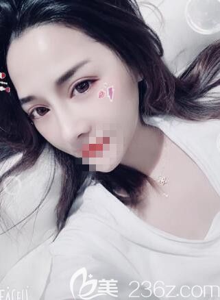 實話實說：在鄭州藝齡做的鼻綜合整形的確是我一生都不會后悔的決定