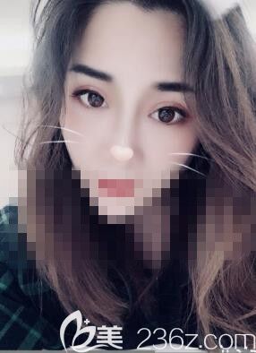 在鄭州藝齡做鼻綜合10天 在鄭州藝齡做鼻綜合10天