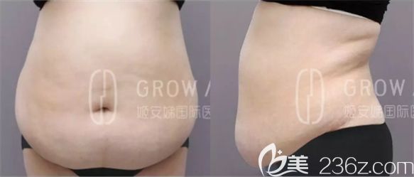 長(zhǎng)春姬安娣整形吸脂減肥術(shù)前圖 長(zhǎng)春姬安娣整形吸脂減肥術(shù)前圖
