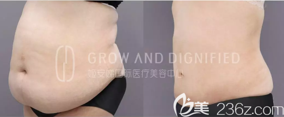 長(zhǎng)春姬安娣整形吸脂瘦腹前后效果對(duì)比圖 長(zhǎng)春姬安娣整形吸脂瘦腹前后效果對(duì)比圖