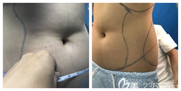做腰腹部吸脂術(shù)前贅肉較多 做腰腹部吸脂術(shù)前贅肉較多