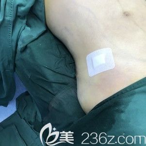 腰腹部吸脂術(shù)后針眼位置 腰腹部吸脂術(shù)后針眼位置
