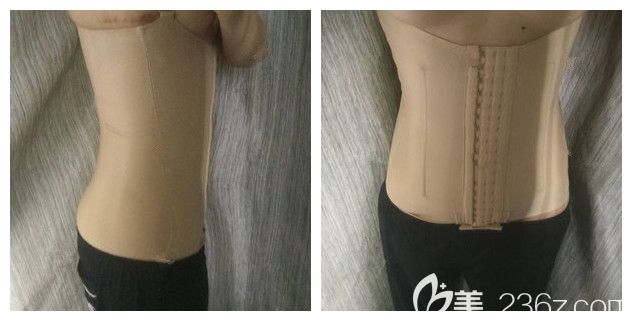 術(shù)后半個(gè)月穿著塑身衣腰腹部吸脂恢復(fù)情況 術(shù)后半個(gè)月穿著塑身衣腰腹部吸脂恢復(fù)情況