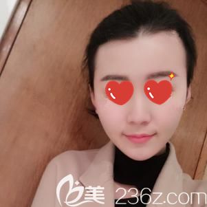 做光纖溶脂瘦臉術(shù)后16天臉部紅腫消失