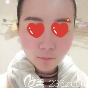 汪洋主任幫我做光纖溶脂術(shù)后效果