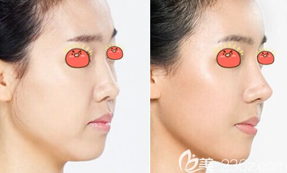 康寧膨體假體隆鼻案例