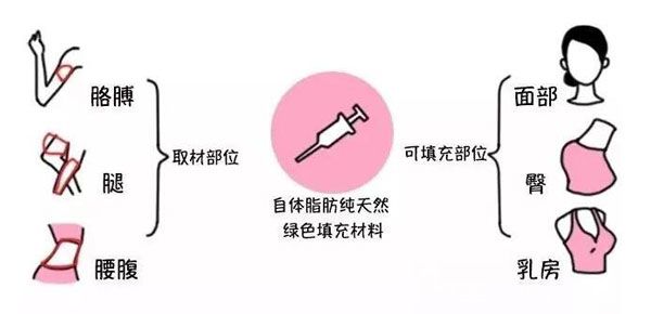 自體脂肪面部填充哪個(gè)部位成活率高 自體脂肪面部填充哪個(gè)部位成活率高