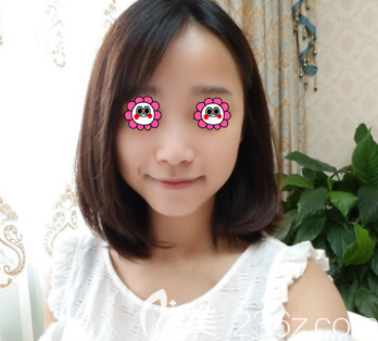 我在北京藝美注射海薇玻尿酸豐唇前樣子 我在北京藝美注射海薇玻尿酸豐唇前樣子