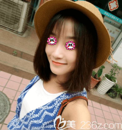 北京藝美范憲紅海薇玻尿酸豐唇案例 北京藝美范憲紅海薇玻尿酸豐唇案例